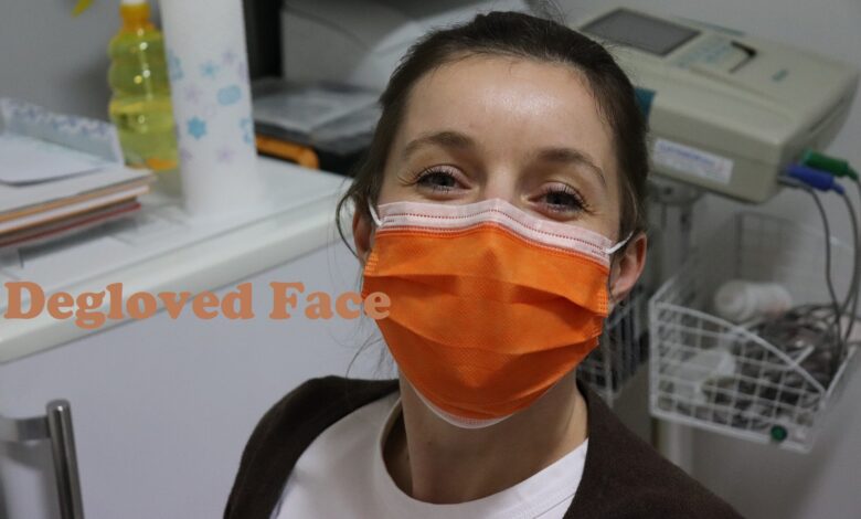 Degloved Face
